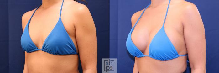 Before & After Breast Augmentation Case 701 Bikini Left Oblique View in Los Angeles & Torrance, CA, CA