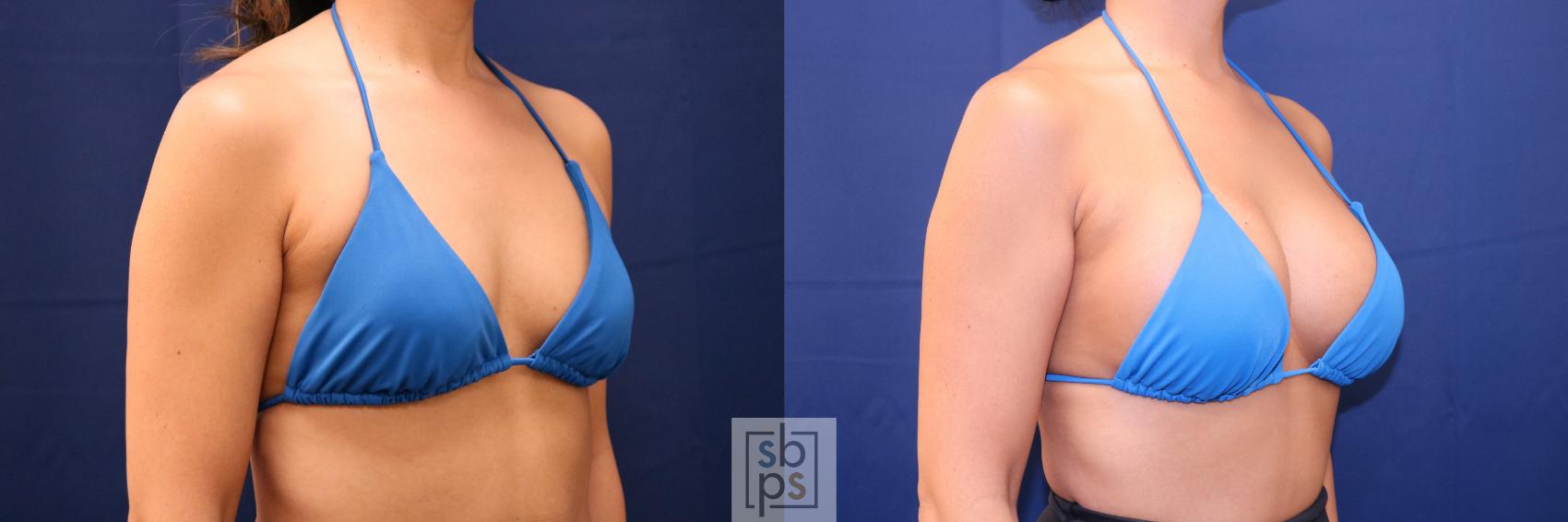 Before & After Breast Augmentation Case 701 Bikini Right Oblique View in Torrance & Los Angeles, CA, CA