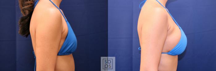 Before & After Breast Augmentation Case 701 Bikini Right View in Los Angeles & Torrance, CA, CA