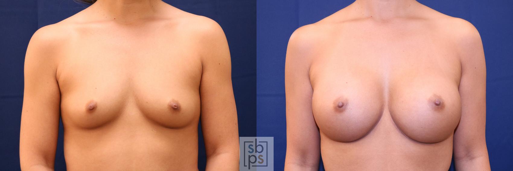 Before & After Breast Augmentation Case 701 Front View in Los Angeles & Torrance, CA, CA