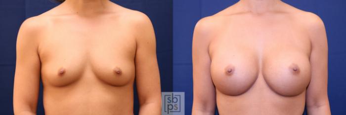 Before & After Breast Augmentation Case 701 Front View in Los Angeles & Torrance, CA, CA