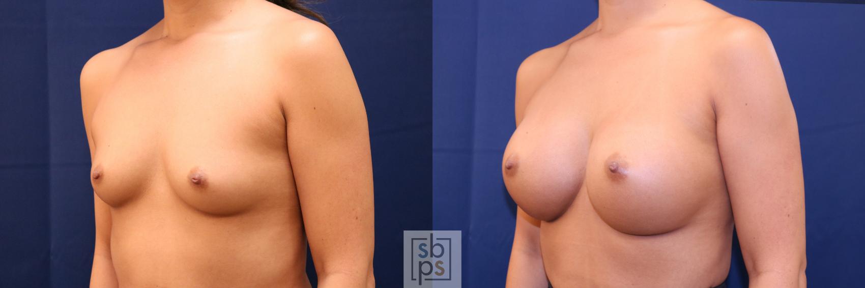 Before & After Breast Augmentation Case 701 Left Oblique View in Torrance & Los Angeles, CA, CA
