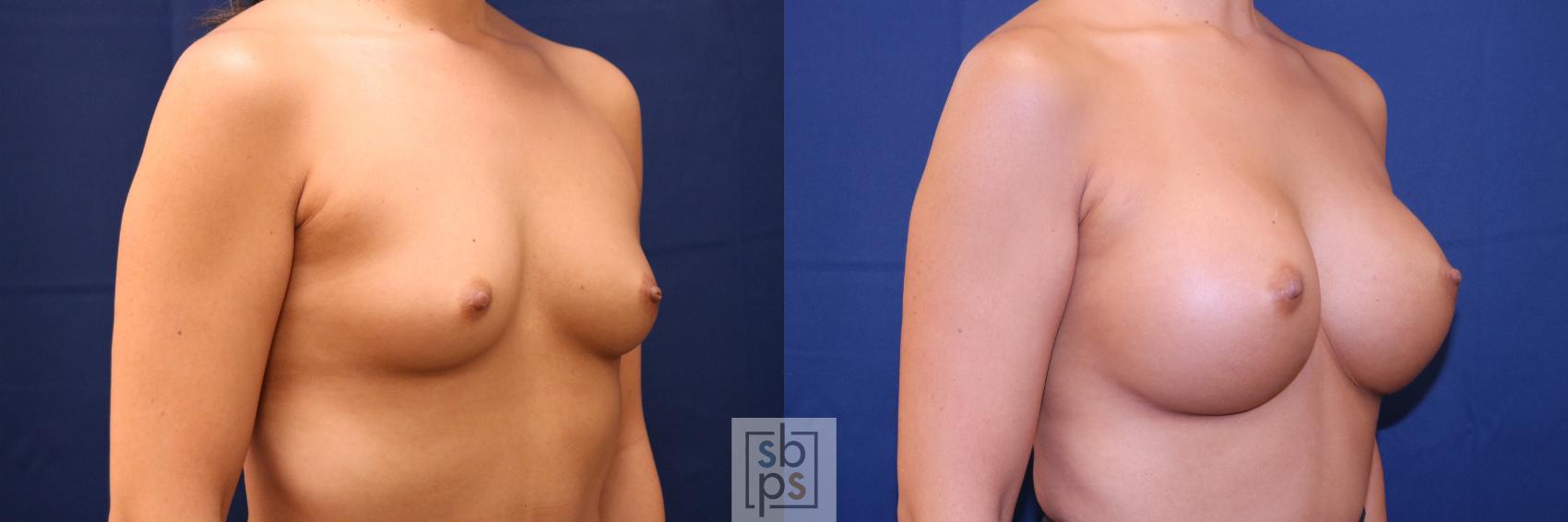 Before & After Breast Augmentation Case 701 Right Oblique View in Torrance & Los Angeles, CA, CA