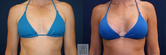 Before & After Breast Augmentation Case 703 Bikini Front View in Los Angeles & Torrance, CA, CA