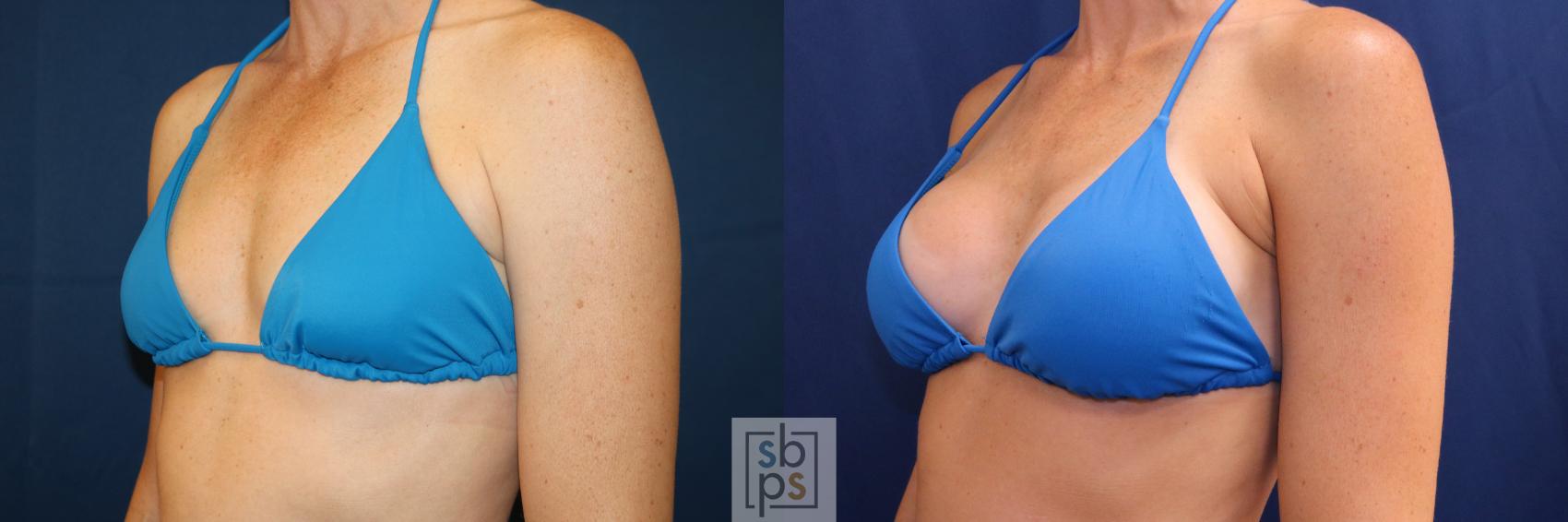 Before & After Breast Augmentation Case 703 Bikini Left Oblique View in Torrance & Los Angeles, CA, CA