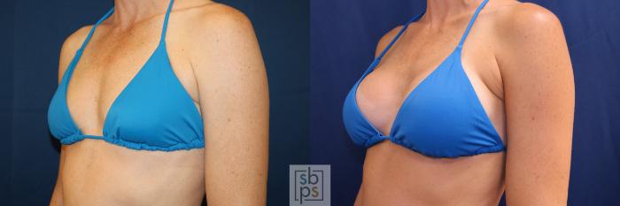 Before & After Breast Augmentation Case 703 Bikini Left Oblique View in Los Angeles & Torrance, CA, CA