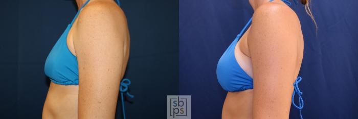 Before & After Breast Augmentation Case 703 Bikini Left View in Los Angeles & Torrance, CA, CA