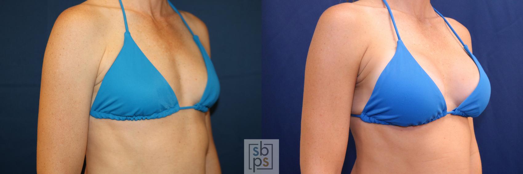 Before & After Breast Augmentation Case 703 Bikini Right Oblique View in Torrance & Los Angeles, CA, CA