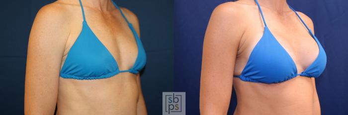 Before & After Breast Augmentation Case 703 Bikini Right Oblique View in Los Angeles & Torrance, CA, CA