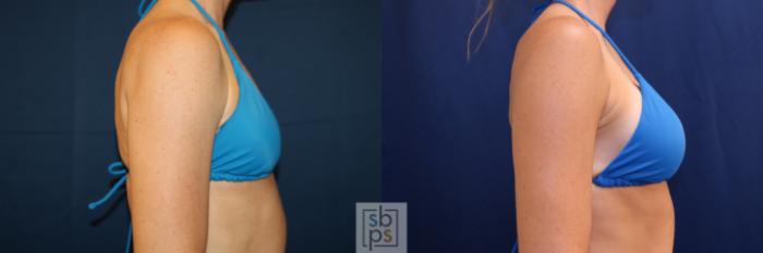 Before & After Breast Augmentation Case 703 Bikini Right View in Los Angeles & Torrance, CA, CA