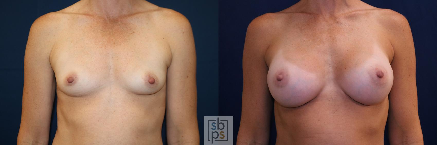 Before & After Breast Augmentation Case 703 Front View in Los Angeles & Torrance, CA, CA