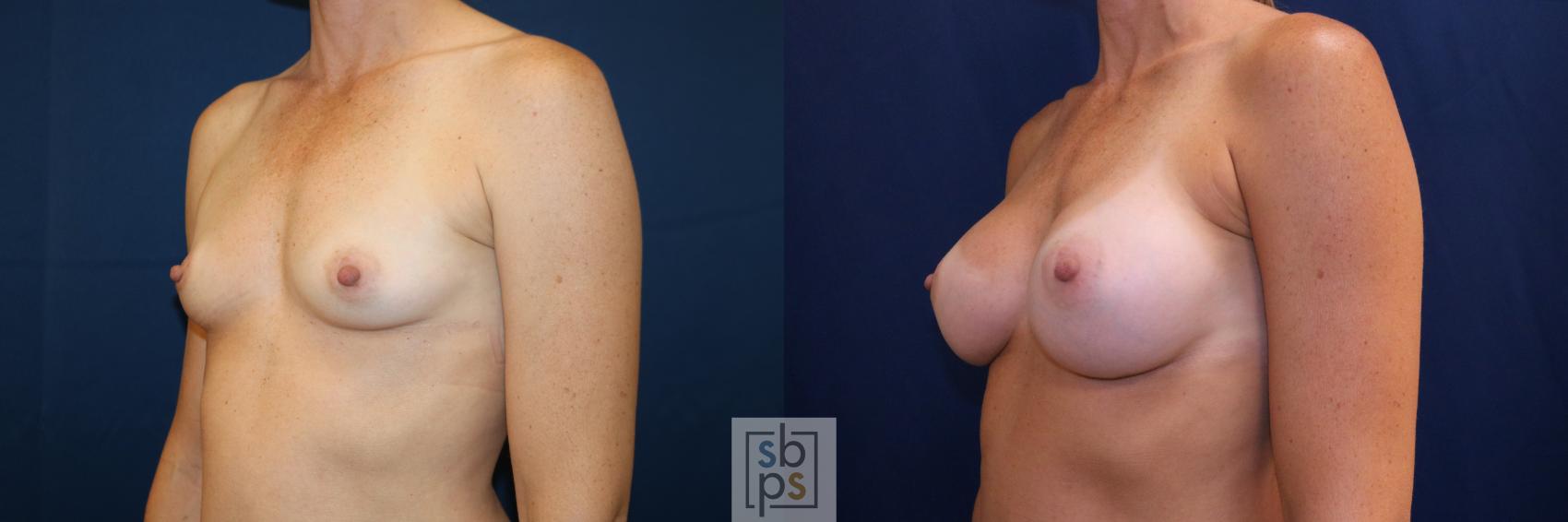 Before & After Breast Augmentation Case 703 Left Oblique View in Torrance & Los Angeles, CA, CA