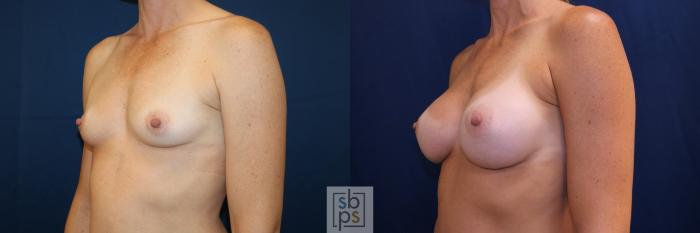 Before & After Breast Augmentation Case 703 Left Oblique View in Los Angeles & Torrance, CA, CA