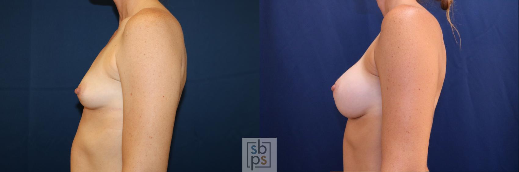 Before & After Breast Augmentation Case 703 Left Side View in Torrance & Los Angeles, CA, CA