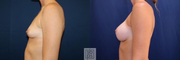 Before & After Breast Augmentation Case 703 Left Side View in Los Angeles & Torrance, CA, CA