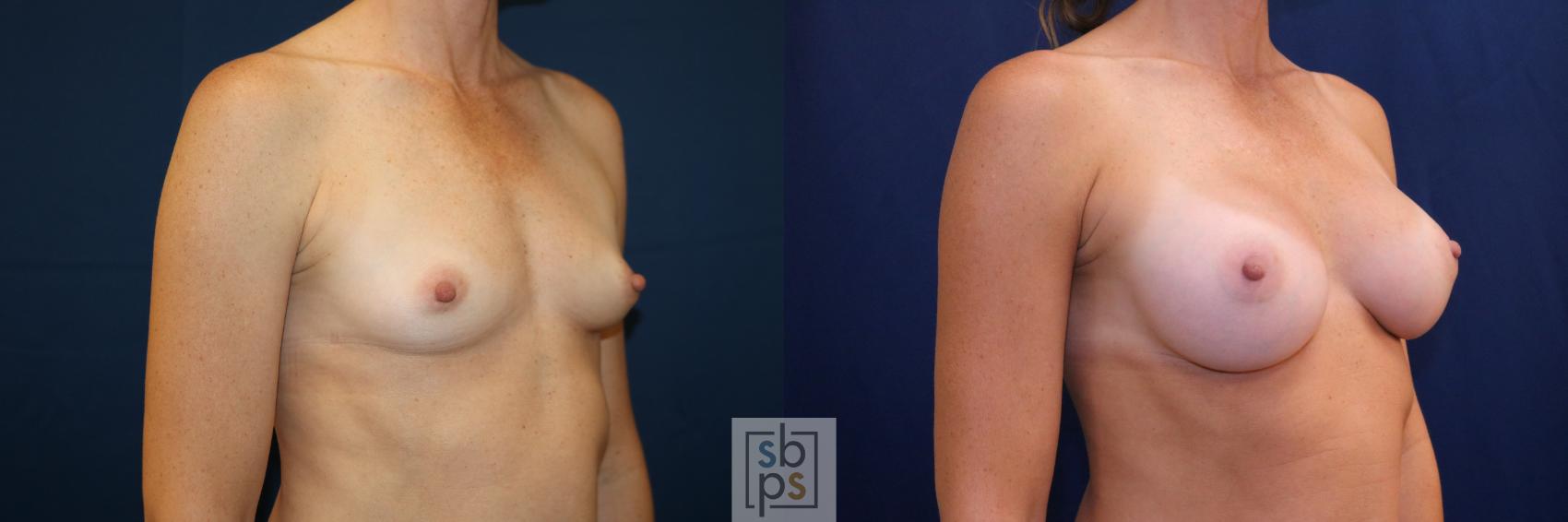 Before & After Breast Augmentation Case 703 Right Oblique View in Torrance & Los Angeles, CA, CA