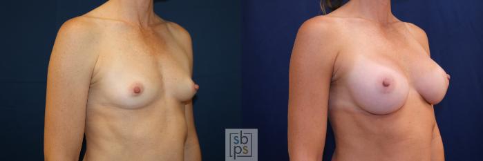 Before & After Breast Augmentation Case 703 Right Oblique View in Los Angeles & Torrance, CA, CA