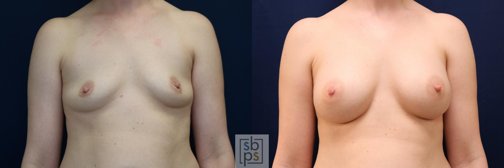 Before & After Breast Augmentation Case 704 Front View in Los Angeles & Torrance, CA, CA