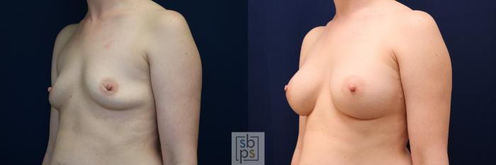 Before & After Breast Augmentation Case 704 Left Oblique View in Los Angeles & Torrance, CA, CA