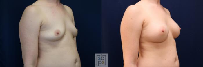 Before & After Breast Augmentation Case 704 Right Oblique View in Los Angeles & Torrance, CA, CA