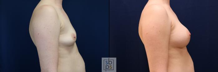 Before & After Breast Augmentation Case 704 Right Side View in Los Angeles & Torrance, CA, CA