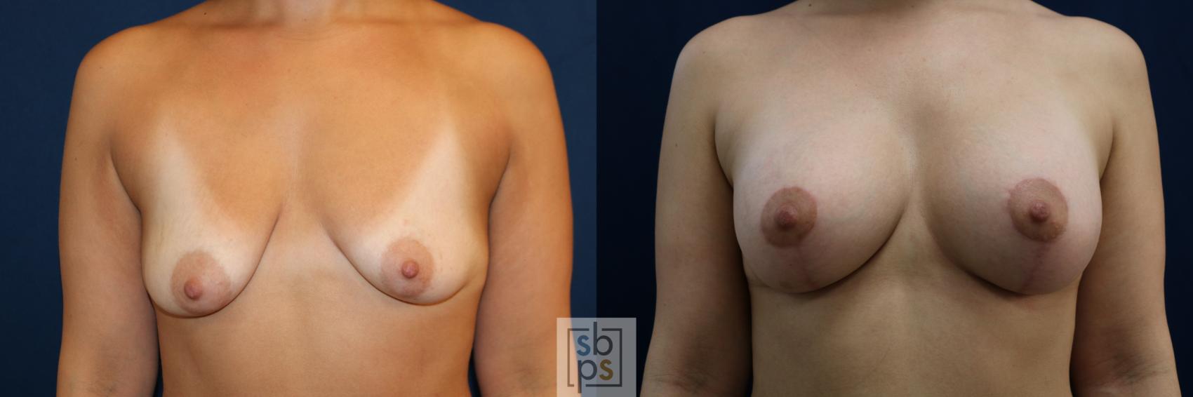 Before & After Breast Augmentation Case 711 Front View in Los Angeles & Torrance, CA, CA