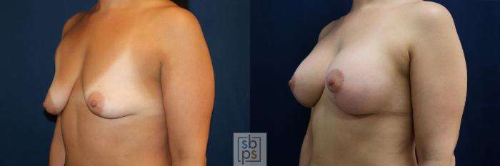 Before & After Breast Augmentation Case 711 Left Oblique View in Los Angeles & Torrance, CA, CA