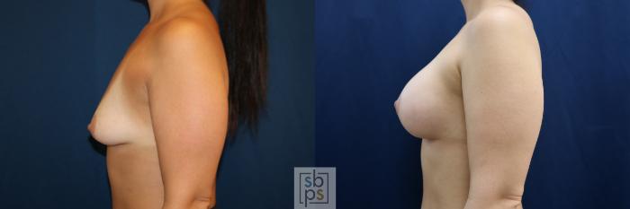 Before & After Breast Augmentation Case 711 Left Side View in Los Angeles & Torrance, CA, CA