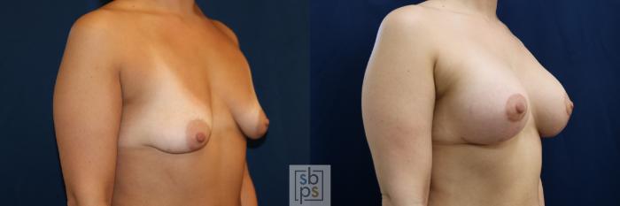 Before & After Breast Augmentation Case 711 Right Oblique View in Los Angeles & Torrance, CA, CA