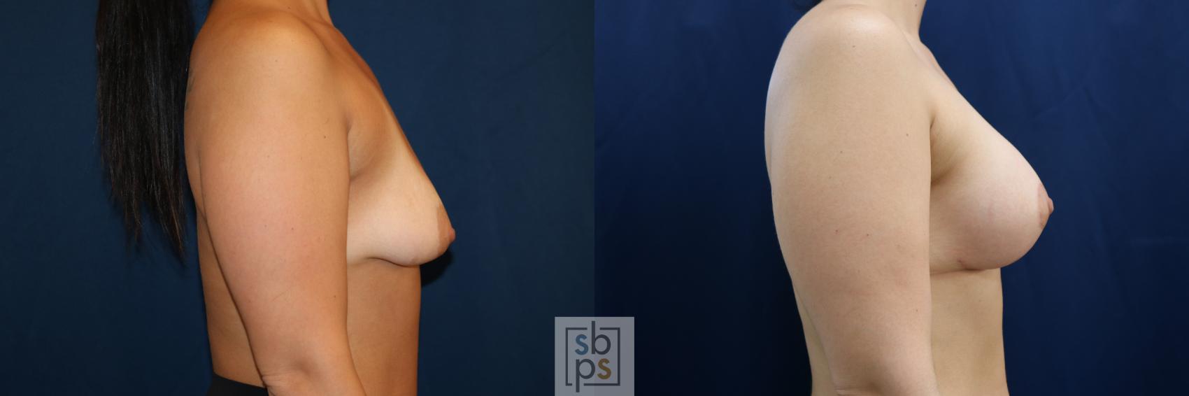 Before & After Breast Augmentation Case 711 Right Side View in Torrance & Los Angeles, CA, CA