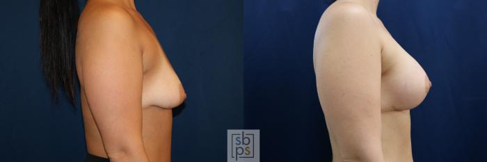 Before & After Breast Augmentation Case 711 Right Side View in Los Angeles & Torrance, CA, CA