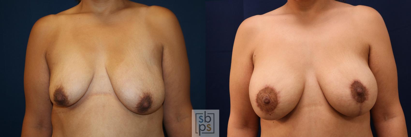 Before & After Breast Augmentation Case 714 Front View in Los Angeles & Torrance, CA, CA