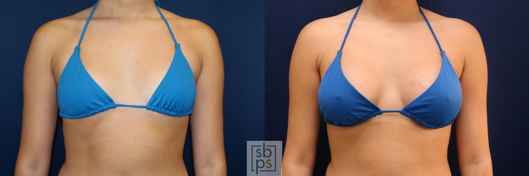 Before & After Breast Augmentation Case 723 Bikini Front View in Torrance & Los Angeles, CA, CA