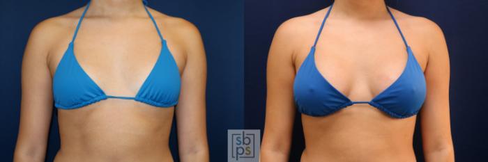 Before & After Breast Augmentation Case 723 Bikini Front View in Los Angeles & Torrance, CA, CA