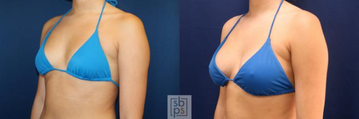 Before & After Breast Augmentation Case 723 Bikini Left Oblique View in Los Angeles & Torrance, CA, CA