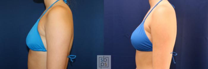 Before & After Breast Augmentation Case 723 Bikini Left View in Los Angeles & Torrance, CA, CA