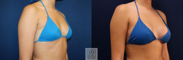 Before & After Breast Augmentation Case 723 Bikini Right Oblique View in Los Angeles & Torrance, CA, CA