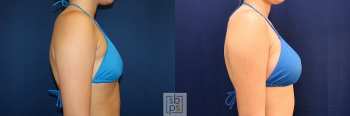 Before & After Breast Augmentation Case 723 Bikini Right View in Los Angeles & Torrance, CA, CA