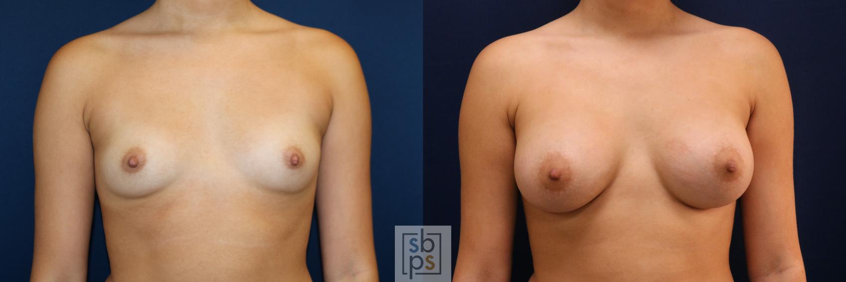 Before & After Breast Augmentation Case 723 Front View in Los Angeles & Torrance, CA, CA