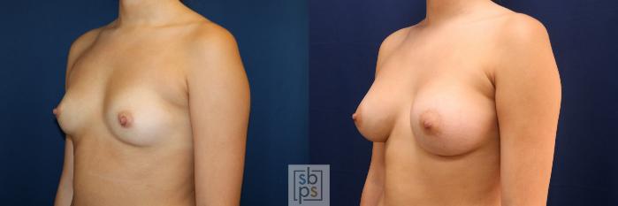 Before & After Breast Augmentation Case 723 Left Oblique View in Los Angeles & Torrance, CA, CA