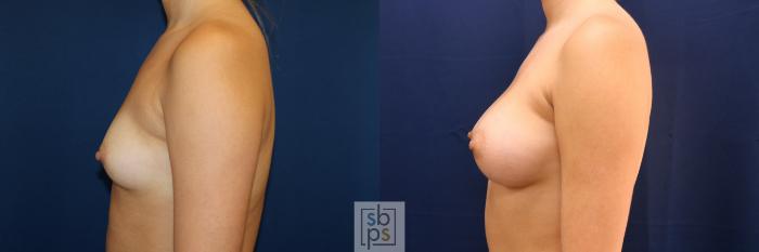 Before & After Breast Augmentation Case 723 Left Side View in Los Angeles & Torrance, CA, CA