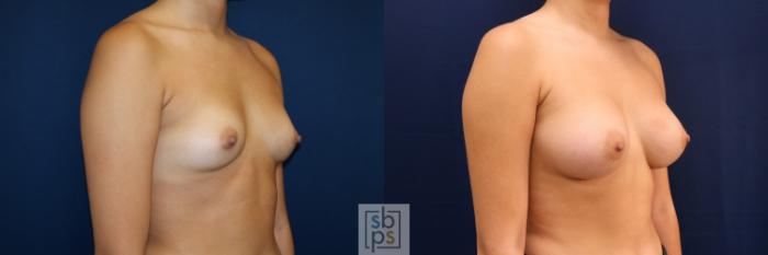 Before & After Breast Augmentation Case 723 Right Oblique View in Los Angeles & Torrance, CA, CA