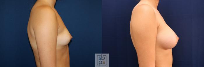 Before & After Breast Augmentation Case 723 Right Side View in Los Angeles & Torrance, CA, CA