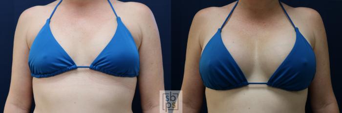 Before & After Breast Augmentation Case 729 Bikini Front View in Los Angeles & Torrance, CA, CA