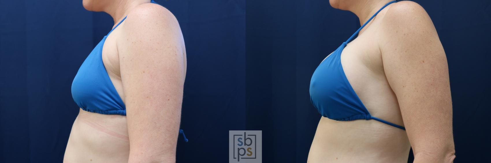 Before & After Breast Augmentation Case 729 Bikini Left View in Torrance & Los Angeles, CA, CA