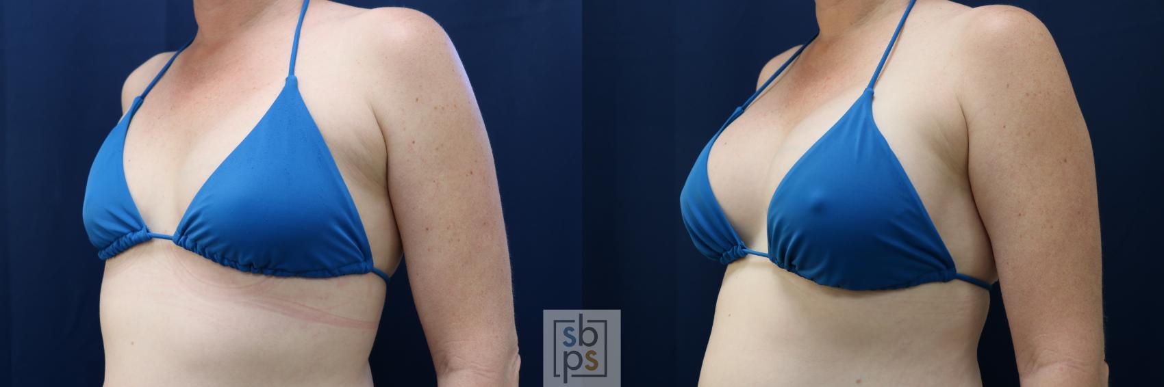 Before & After Breast Augmentation Case 729 Bikini Left Oblique View in Torrance & Los Angeles, CA, CA