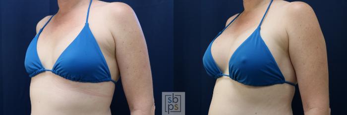 Before & After Breast Augmentation Case 729 Bikini Left Oblique View in Los Angeles & Torrance, CA, CA