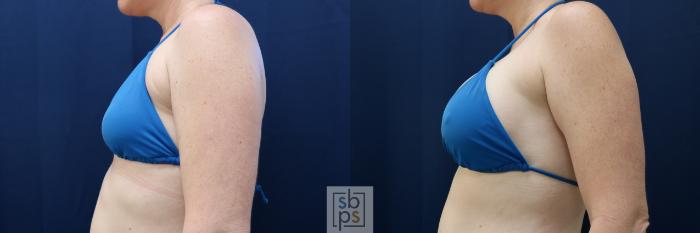 Before & After Breast Augmentation Case 729 Bikini Left View in Los Angeles & Torrance, CA, CA