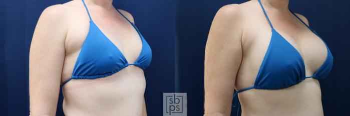 Before & After Breast Augmentation Case 729 Bikini Right Oblique View in Los Angeles & Torrance, CA, CA