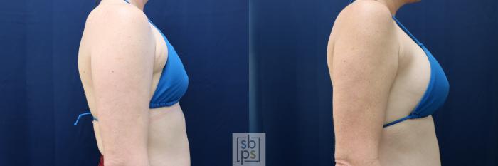 Before & After Breast Augmentation Case 729 Bikini Right View in Los Angeles & Torrance, CA, CA